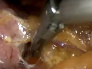 Laparoscopic surgery